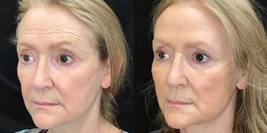 Cosmetic Procedure before and after photo by Kristin J. Tarbet, M.D. in Bellevue, WA