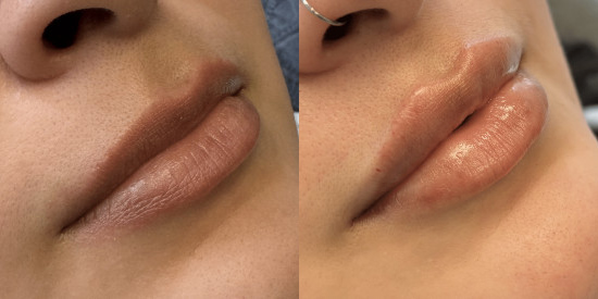 Injectables before and after photo by Kristin J. Tarbet, M.D. in Bellevue, WA