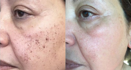 IPL before and after photo by Kristin J. Tarbet, M.D. in Bellevue, WA