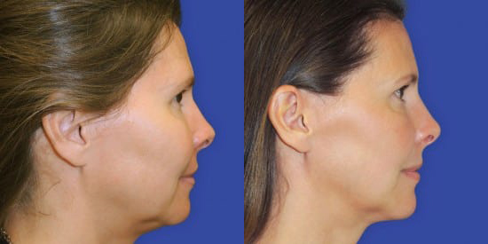 Kybella before and after photo by Kristin J. Tarbet, M.D. in Bellevue, WA