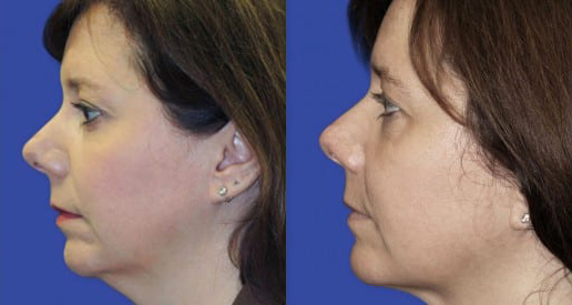 Kybella before and after photo by Kristin J. Tarbet, M.D. in Bellevue, WA