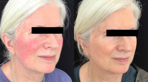 Laser Genesis before and after photo by Kristin J. Tarbet, M.D. in Bellevue, WA