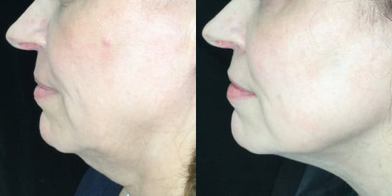 Silhouette InstaLift before and after photo by Kristin J. Tarbet, M.D. in Bellevue, WA