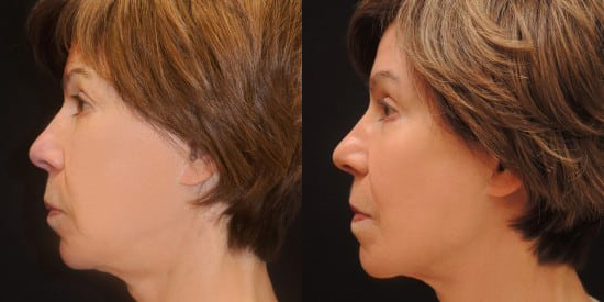 Ultherapy before and after photo by Kristin J. Tarbet, M.D. in Bellevue, WA