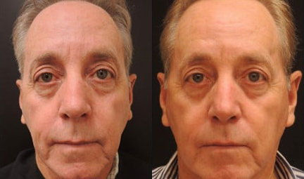 Ultherapy before and after photo by Kristin J. Tarbet, M.D. in Bellevue, WA