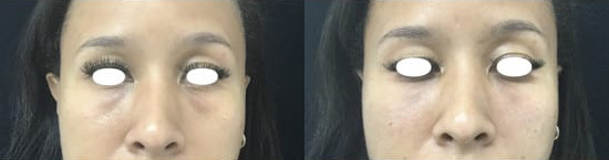 Undereye filler before and after photo by Kristin J. Tarbet, M.D. in Bellevue, WA