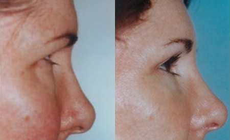 Blepharoplasty (Eyelid Surgery) before and after photo by Kristin J. Tarbet, M.D. in Bellevue, WA