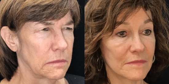 Blepharoplasty (Eyelid Surgery) before and after photo by Kristin J. Tarbet, M.D. in Bellevue, WA