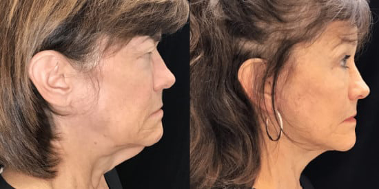 Blepharoplasty (Eyelid Surgery) before and after photo by Kristin J. Tarbet, M.D. in Bellevue, WA