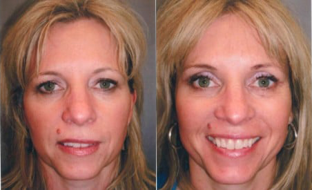 Brow Lift before and after photo by Kristin J. Tarbet, M.D. in Bellevue, WA