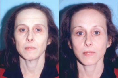 Brow Lift before and after photo by Kristin J. Tarbet, M.D. in Bellevue, WA