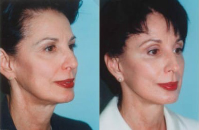 Facelift before and after photo by Kristin J. Tarbet, M.D. in Bellevue, WA