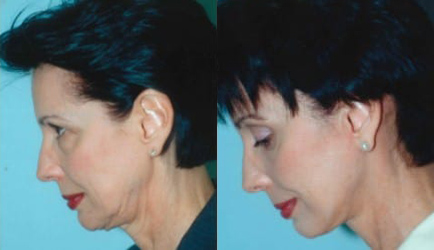 Facelift before and after photo by Kristin J. Tarbet, M.D. in Bellevue, WA