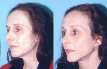 Facelift before and after photo by Kristin J. Tarbet, M.D. in Bellevue, WA