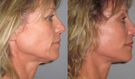 Facelift before and after photo by Kristin J. Tarbet, M.D. in Bellevue, WA