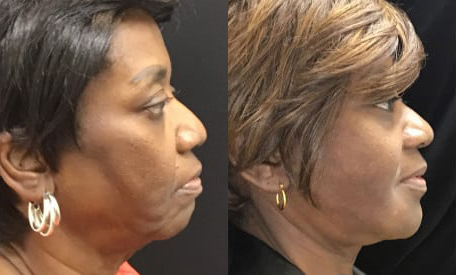 Facelift before and after photo by Kristin J. Tarbet, M.D. in Bellevue, WA