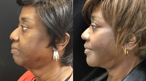 Facelift before and after photo by Kristin J. Tarbet, M.D. in Bellevue, WA