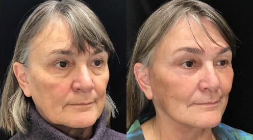 Facelift before and after photo by Kristin J. Tarbet, M.D. in Bellevue, WA