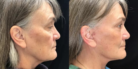 Facelift before and after photo by Kristin J. Tarbet, M.D. in Bellevue, WA