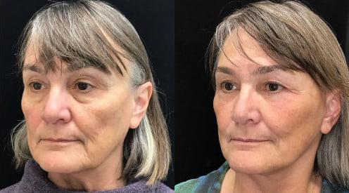 Facelift before and after photo by Kristin J. Tarbet, M.D. in Bellevue, WA