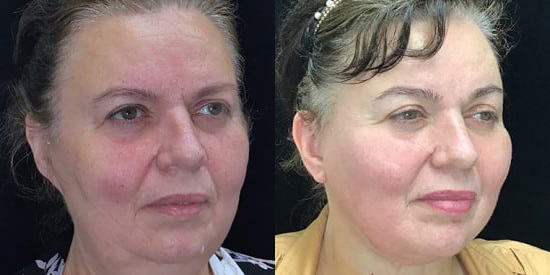 Facelift before and after photo by Kristin J. Tarbet, M.D. in Bellevue, WA