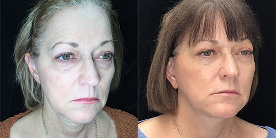 Facelift before and after photo by Kristin J. Tarbet, M.D. in Bellevue, WA