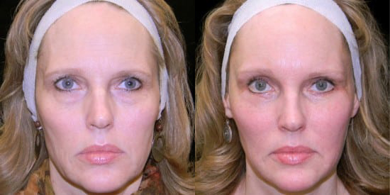 Fat Transfer before and after photo by Kristin J. Tarbet, M.D. in Bellevue, WA