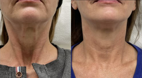 Xeomin for neck bands before and after photo by Kristin J. Tarbet, M.D. in Bellevue, WA