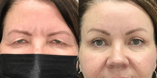 Endoscopic Browlift before and after photo by Kristin J. Tarbet, M.D. in Bellevue, WA