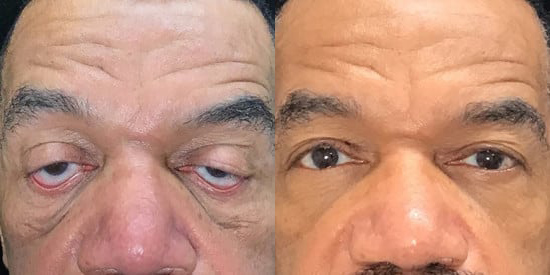 Ptosis Repair before and after photo by Kristin J. Tarbet, M.D. in Bellevue, WA