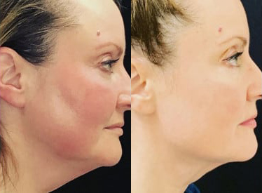 FaceTite before and after photo by Kristin J. Tarbet, M.D. in Bellevue, WA