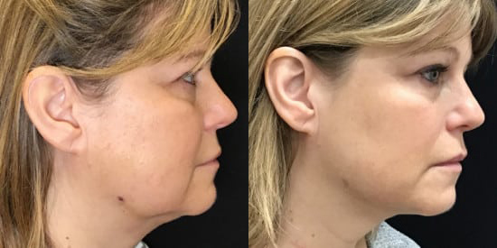 FaceTite before and after photo by Kristin J. Tarbet, M.D. in Bellevue, WA