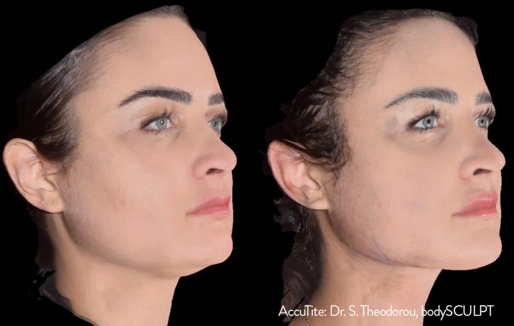 accutite before after